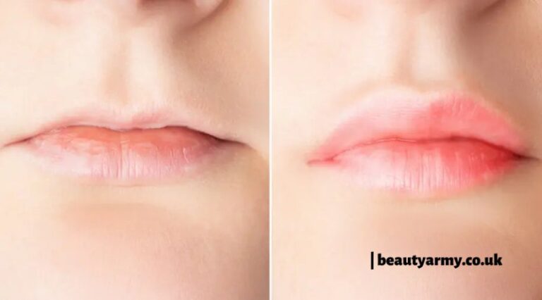 Complete Guide About Lip filler Treatment